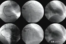 冠脉造影检查对人体有什么危害？图片