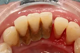 牙缝里的“小石头”，只靠刷牙是不行的！洗牙的4个误会一次说清图片