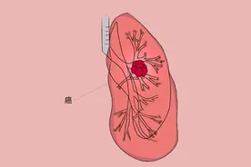 炎症被当做癌症治疗，化疗了3次才发现误诊，是咋回事？图片