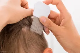 隔一天不洗头，就满头都是头皮屑？与3个原因脱不了干系图片