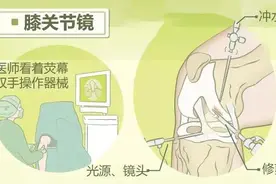 膝盖痛，膝关节镜有帮助吗？图片