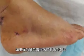 脚后跟肌腱损伤断裂，工伤可以评几级伤残呢？千里之行，死于卒图片
