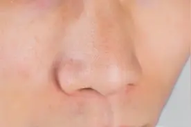 鼻翼处，老是会泛红脱皮图片