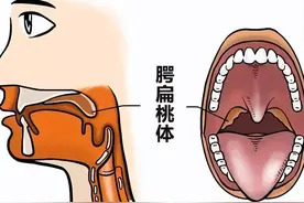 扁桃体为什么容易发炎，总惹麻烦的扁桃体，摘掉还是不摘好？图片