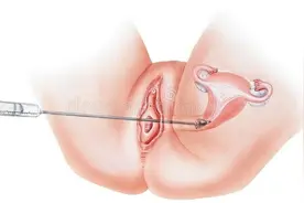 输卵管造影到底有多疼?专家：其实没你想象中那么疼!图片