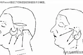 不了解拉皮手术发展史，做“假拉皮”留疤的几率会很高图片