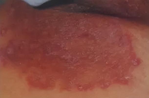 鏄ュぉ鐨偆鐥呰繘鍏ラ珮鍙戝锛佽繖浠界敤鑽ぇ鍏ㄨ鏀跺ソ