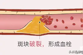 血管长斑块的原因有哪些，该如何预防？图片