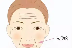 去除脸上的法令纹？不一定要做拉皮手术图片