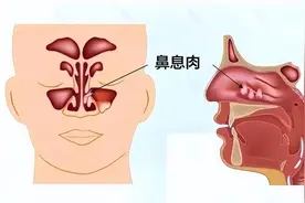 鼻息肉不切除可能会癌变，这是真的吗？图片