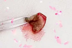 门医技术 | 外阴小肿物，病理大问题！图片