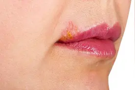 嘴角总长小水泡，多半与4个原因有关，想要治疗它，需做好3件事！图片