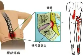 腰椎管狭窄很多人都误认为是腰间盘突出，该如何区分？图片