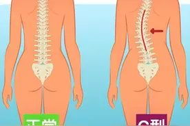 C型脊柱侧弯？S型脊柱侧弯有什么不同？都该怎么治疗？图片