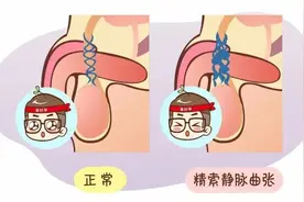 这种“蚯蚓”会影响生育！每十个男性就有一人中招，出现这些症状要警惕图片