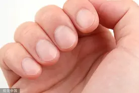 指甲有竖纹，就是不健康？这些真相，一定要知道！图片