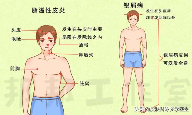 脸皮质角化