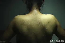 名中医治病绝招 | 顾兆农:止汗验方治自汗图片