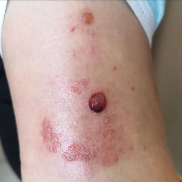 角化棘皮瘤的病理要点
