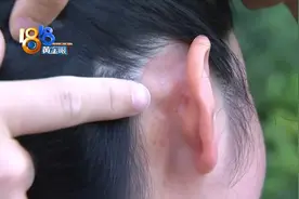 姑娘想要“精灵耳”第三针后动不了图片