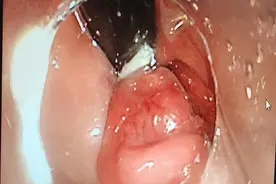 【医疗动态】不开刀治痔疮——内镜下内痔微创治疗图片