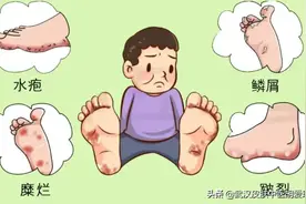 脚上起水泡是什么原因，很痒，用什么药膏图片