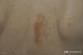 皮肤瘙痒、水泡、红斑、肿胀、死皮，湿疹用什么药好得最快最有效图片