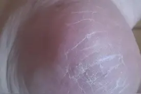 足跟开裂怎么办图片