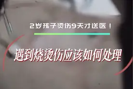 2岁孩子烫伤9天才送医！遇到烧烫伤我们应该如何处理图片