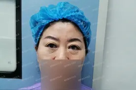 全切双眼皮恢复过程经历真实，看看60岁姐姐全切双眼皮+外切眼袋图片