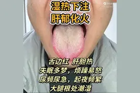 湿热下注、肝郁化火舌象分析图片