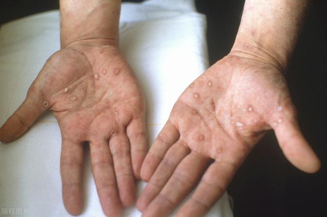 尤其是这几类人,千万要警惕(女的性疾病有哪些) - 冷求网