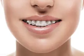 我的经历告诉你，成年人整牙，并没有想象中的那么美好！图片