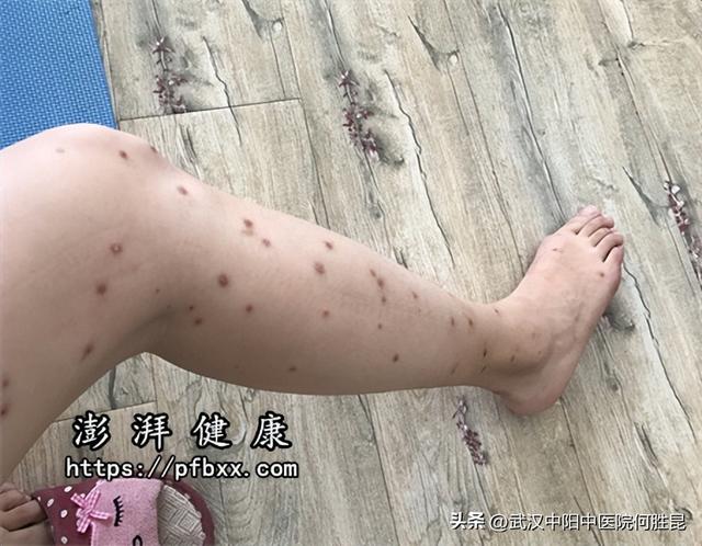 胳膊上起了好多小疙瘩（腿上胳膊上身上长硬硬的凸起疙瘩特别痒）