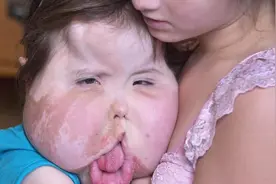 10位患有严重缺陷的孩子，大头女孩，软脖子男孩，脆弱的玻璃女孩图片