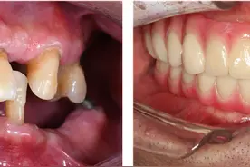 专家分析：三种常见假牙，最好用、最耐用的是这种！图片