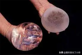 既然能填充，为什么有人喜欢假体隆胸？图片