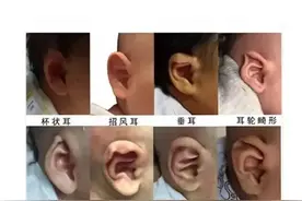 耳廓矫形器（耳模）矫正耳廓畸形的使用时机及注意事项图片