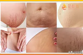 90%孕妈都会长的妊娠纹！5招教你对抗到底！图片