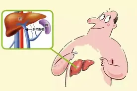 肝硬化早期患者，积极治疗是可以控制的。图片