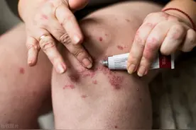 牛皮癣（银屑病）生物制剂有什么副作用图片