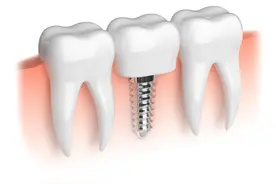 种植牙大揭秘｜种牙是怎么种的？图片