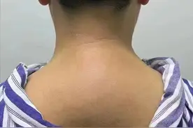 大馒头一样的富贵包，微创手术后后背平了，只留下两个小孔图片