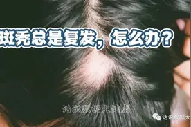 首个获批治疗严重脱发的药物，服用后就像脱发从未发生一样？图片