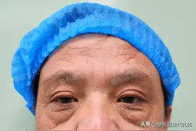 50岁先生做了外切祛眼袋，祛眼袋术后即刻、祛眼袋7天拆线前对比图片