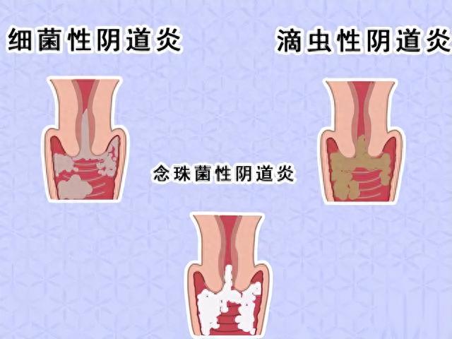 首页>养鸡>正文是女性常见的生殖系统感染性疾病,以细菌性阴道炎,外阴