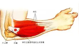 原来这是“网球肘”？不但要防，更要治图片
