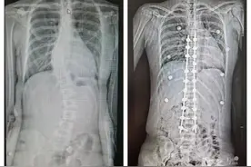 13岁女孩身高超过1米7，父母以为她长得快没在意，没想竟是“天才病”，只能手术！一个动作教你自测图片