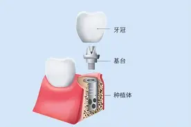 “种牙自由”正式到来！种植牙价格下降50%，一文全攻略图片