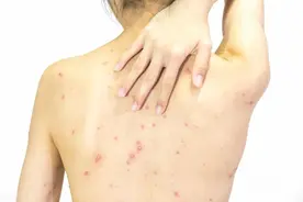 身上出现很多小红点，不痛不痒是怎么回事？这4种病别心存侥幸图片